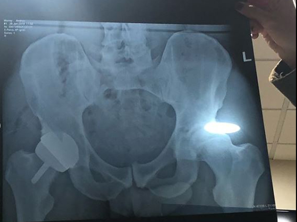 Andy Murray’s X-ray. (Instagram) Andy Murray’s X-ray. (Instagram)